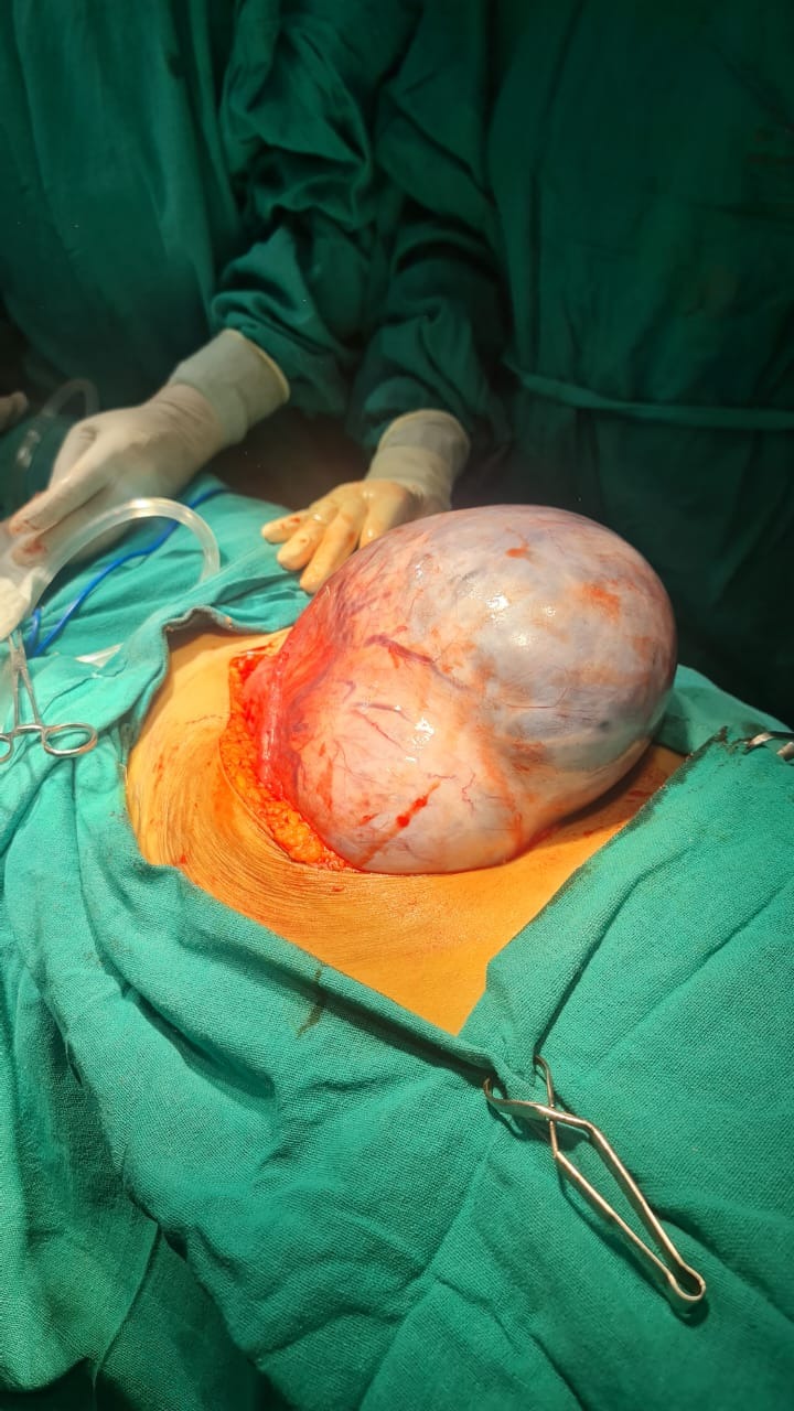 Cervical Cancer