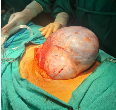 Ovarian Cancer